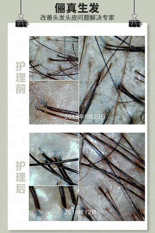 頭油、頭癢