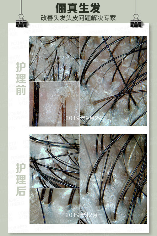 頭油、頭癢